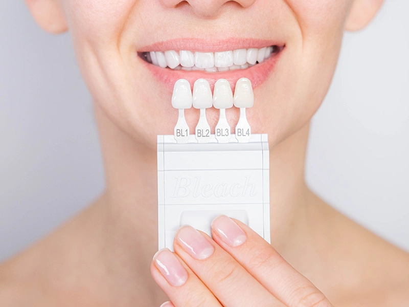 Laminate Veneer Avantajları